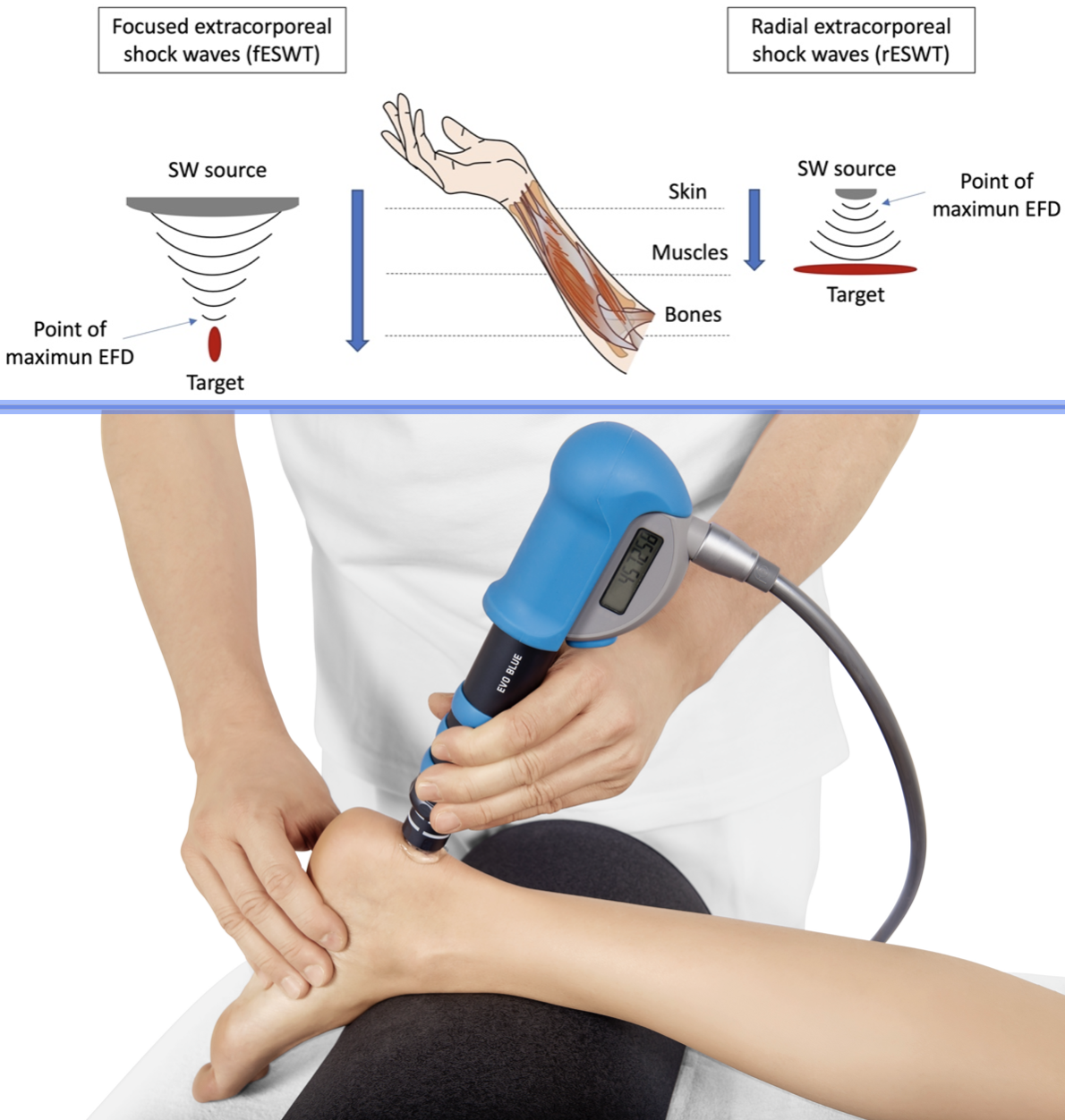 Funktionsweise der Stoßwellentherapie
